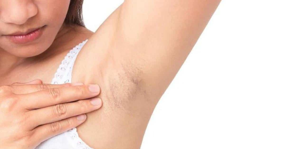 cac-loai-mun-o-nach Nổi mụn ở nách