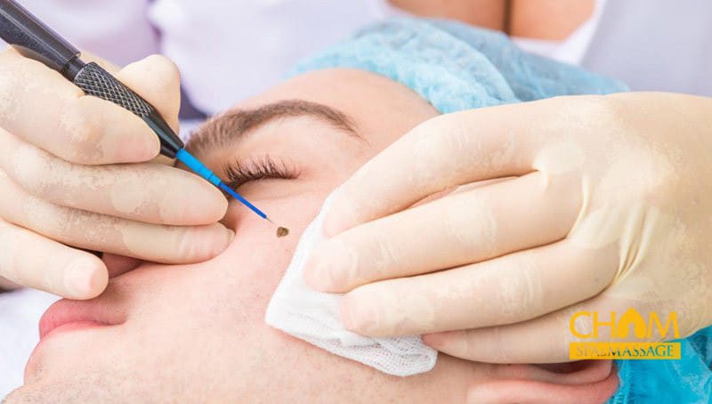 cham-soc-da-sau-khi-tay-not-ruoi-la-dieu-vo-cung-quan-trong-cham-spa-massage Chăm sóc da sau khi tẩy nốt ruồi là điều vô cùng quan trọng Cham Spa & Massage