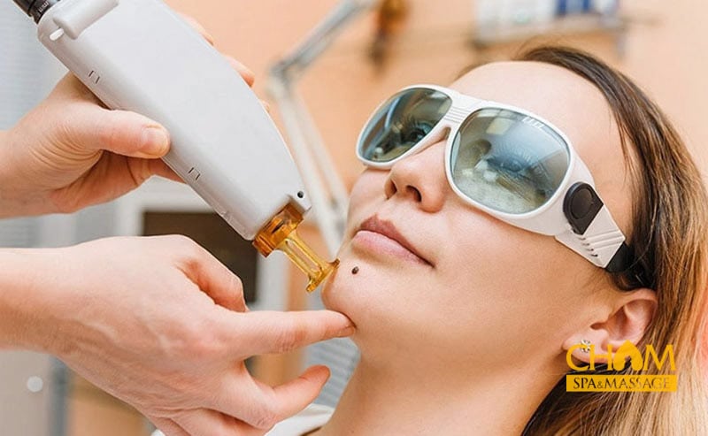 cong-nghe-laser-co2-tay-not-ruoi-tai-cham-spa-massage Công nghệ laser CO2 tẩy nốt ruồi tại Cham Spa & Massage