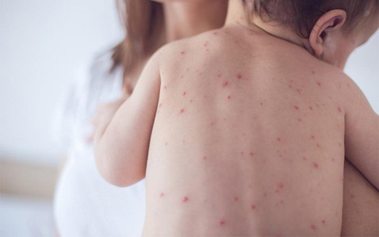 da-noi-cham-do-nhu-not-ruoi-son-khong-ngua Thắc mắc: Da nổi chấm đỏ như nốt ruồi son không ngứa là bị gì? 6