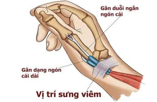 nhat-co-tay-ngan-1 Vị trí đau của hội chứng de quervain