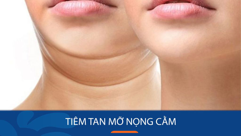 phuong_phap_tiem_tan_mo_nong_cam_co_che_qua_trinh_thuc_hien_va_tac_dung_phu_2_e695392b25 Phương pháp tiêm tan mỡ nọng cằm: Cơ chế, quá trình thực hiện và tác dụng phụ 2