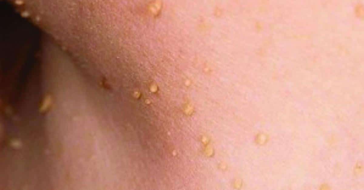 tai-sao-bi-noi-mun-thit-o-co-1 Mụn thịt