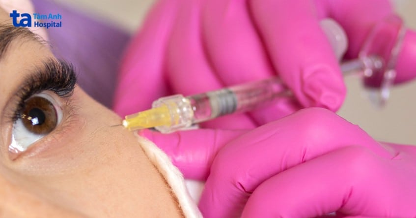 tiem-botox-tri-co-giat-mi-mat tiêm botox trị co giật mí mắt